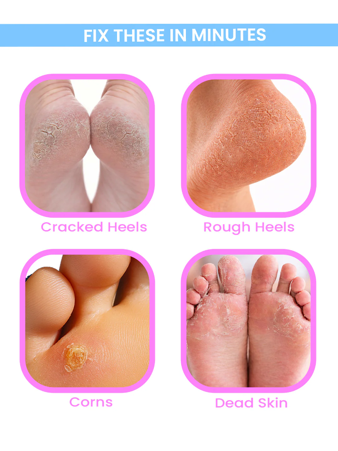 Urban Yog Callus Remover - Image 3