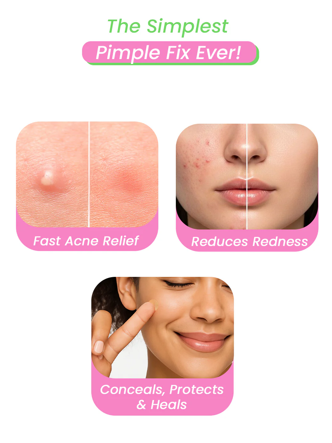 Urban Yog Acne Pimple Patch - Image 3